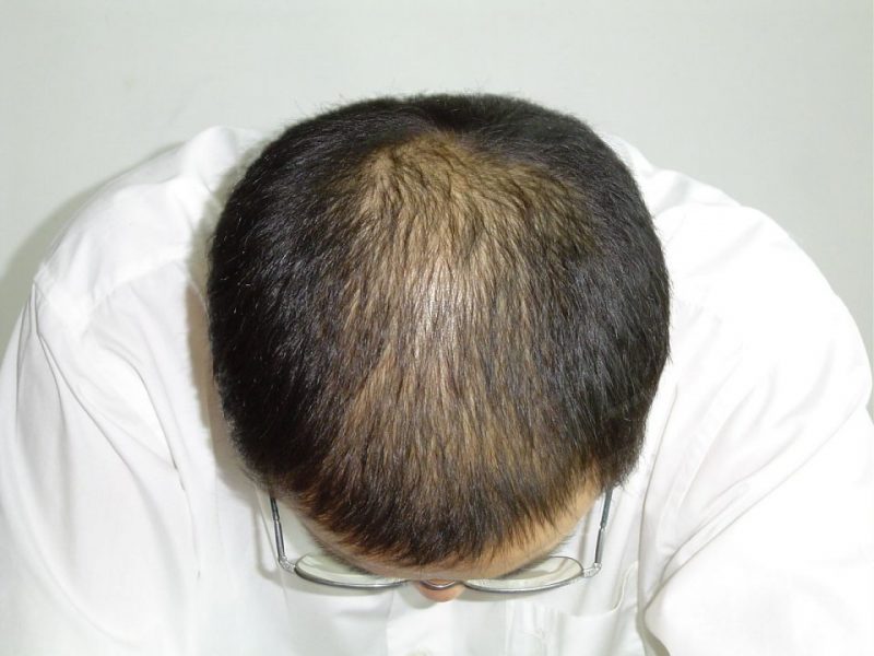 脱发原因有哪些?为什么会脱发?