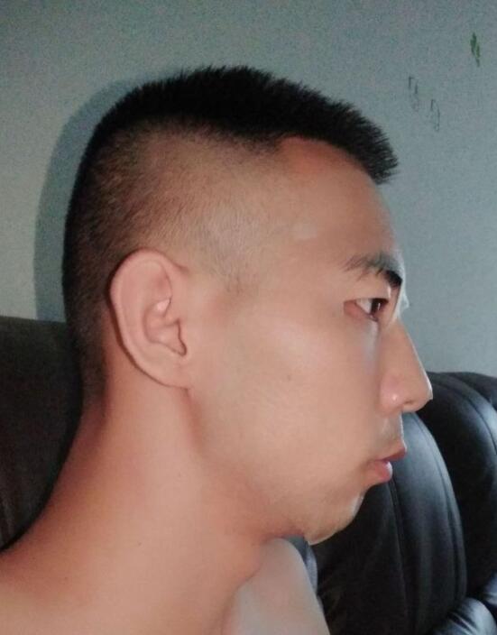 种发植发一般需要多少钱