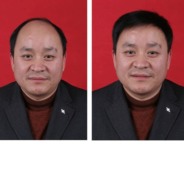 专业补发织发哪里好？织发的优势有哪些