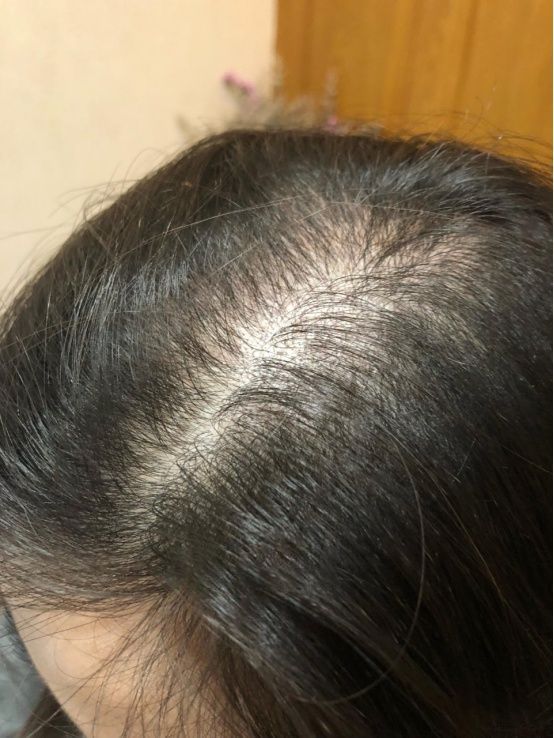 脱发怎么办吃什么能长发？引起脱发的原因有哪些？