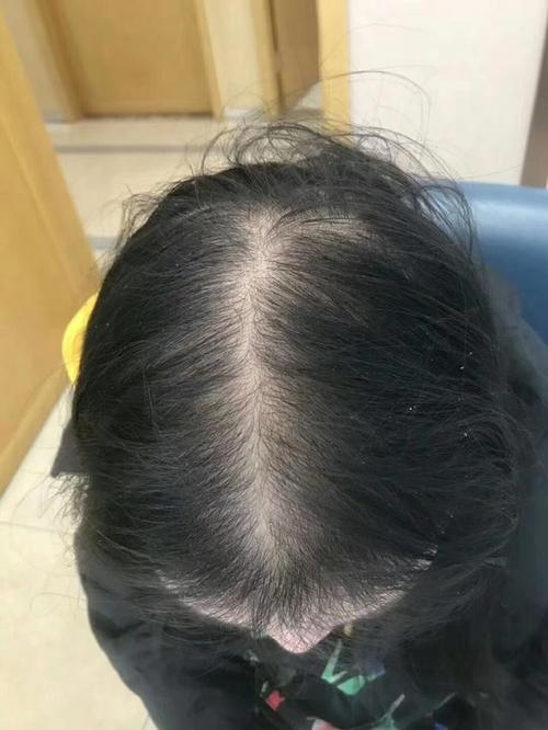 脱发严重怎么办女性