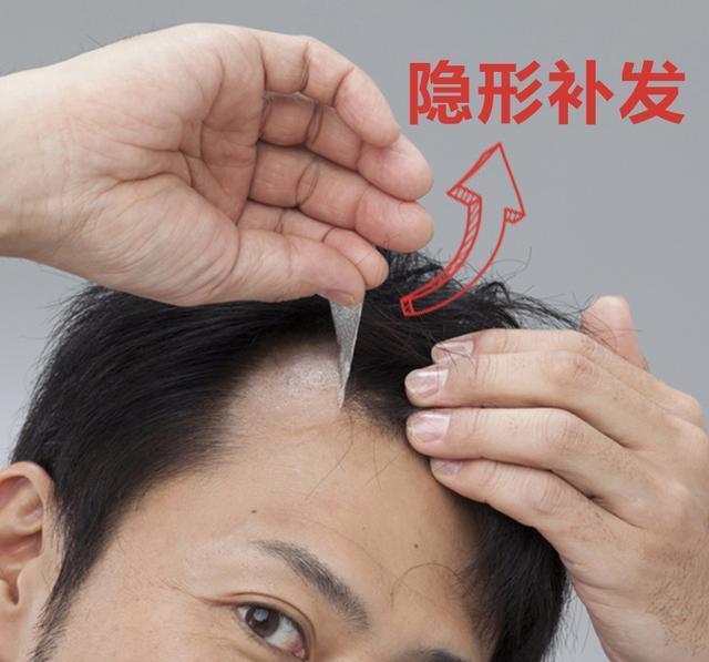 植发费用一般是多少?植发和补发哪个比较好?