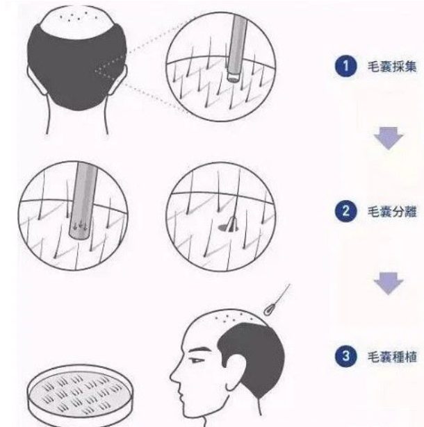 植发一个毛囊多少钱