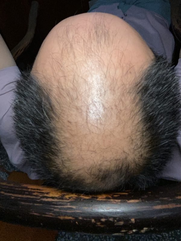脱发的原因和治疗方法，补发的效果怎么样