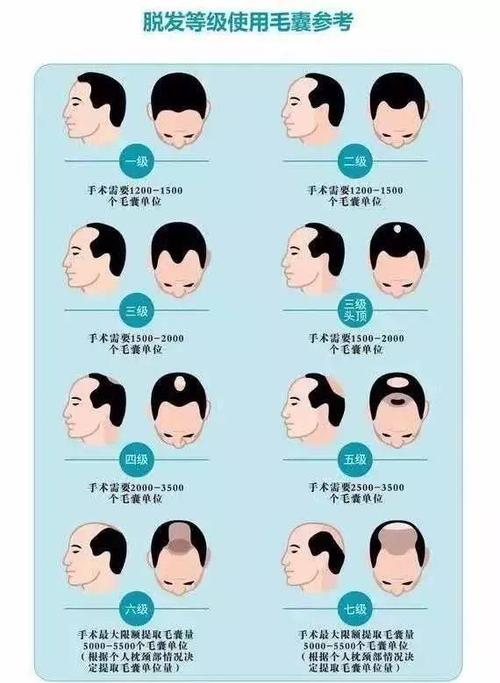 脱发等级 怎样算脱发