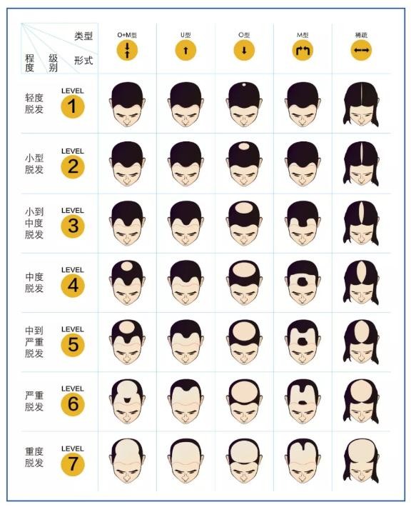 脱发等级  怎样算脱发