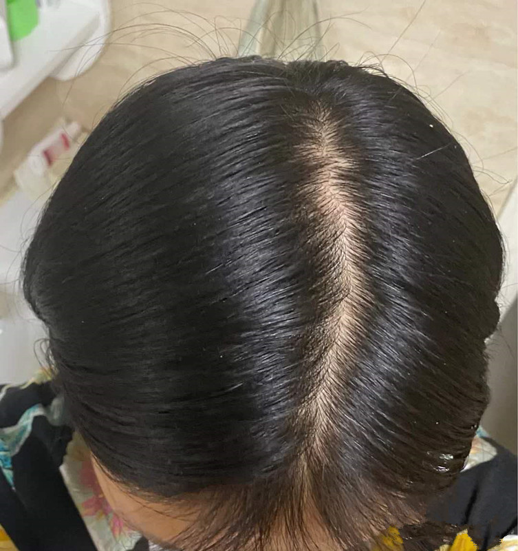 脱发严重吃什么食物好一些？什么食物可以改善脱发？