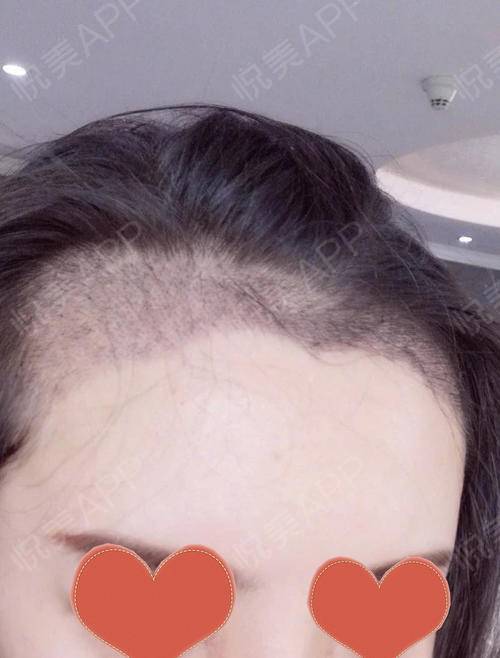 脱发前头发都有哪些预兆，怎么解决脱发问题