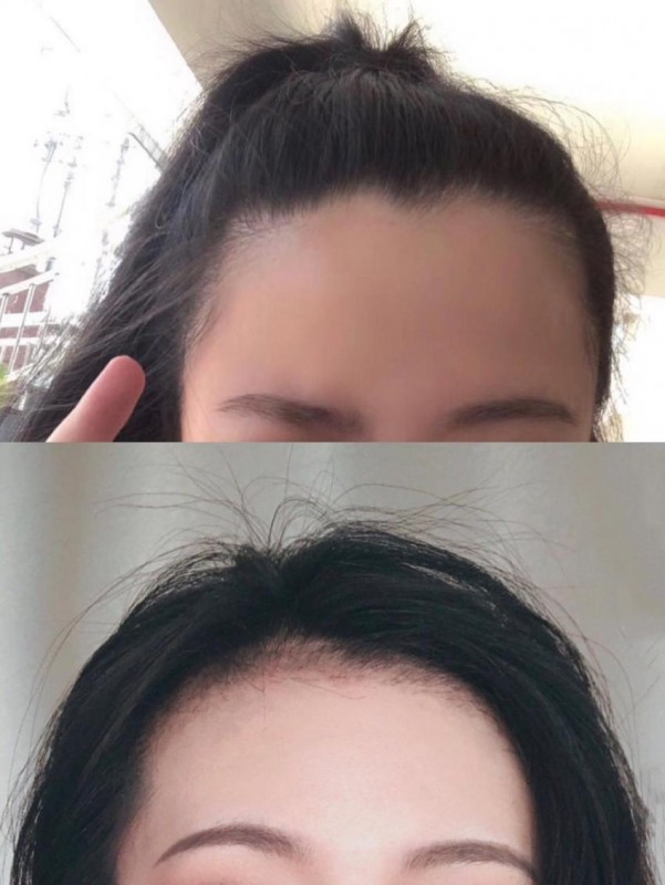总是脱发咋治疗？生发的注意事项有哪些？