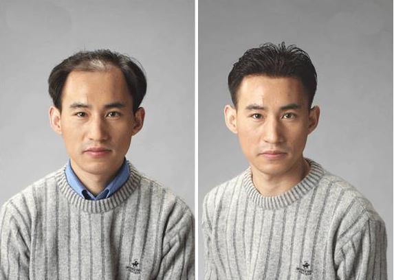 织发补发坏处在哪里呢？织发补发对人体有害吗？