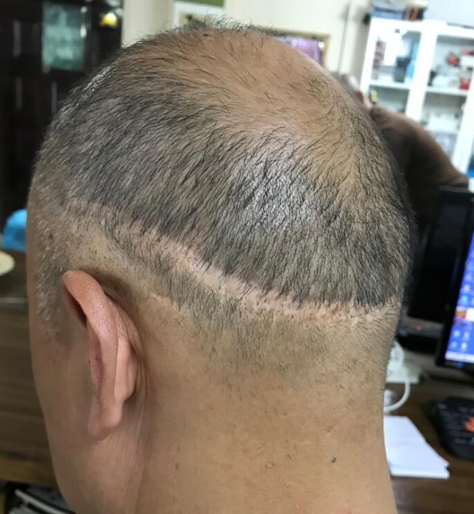 疤痕植发维持多久