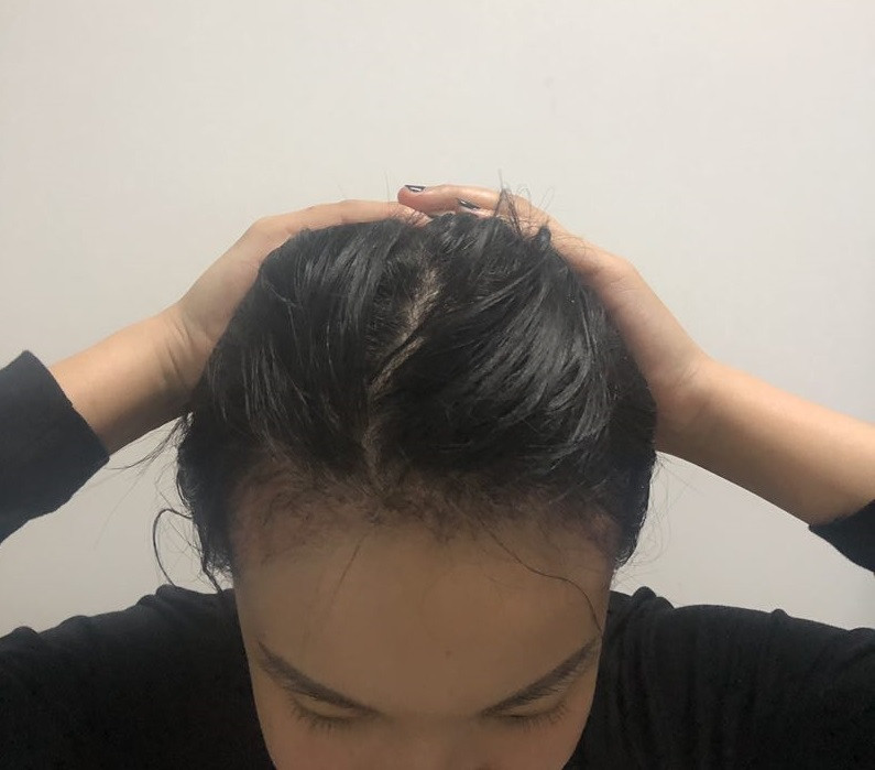 发际线植发可以维持多久呢？如何判断发际线是否后移？