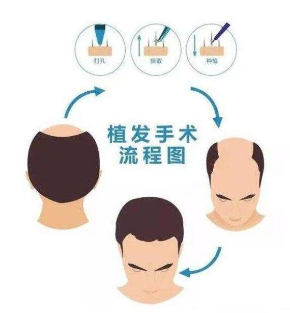 植发的原理是什么？植发有什么危害 危害大吗？