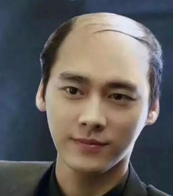 脱发是什么引起的有什么办法治 脱发有什么要注意的