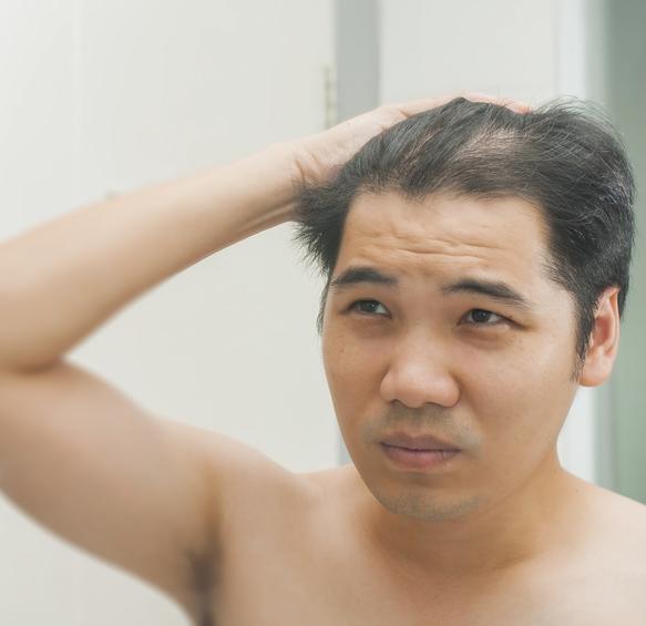 脱发严重怎么办如何生发 脱发严重的原因