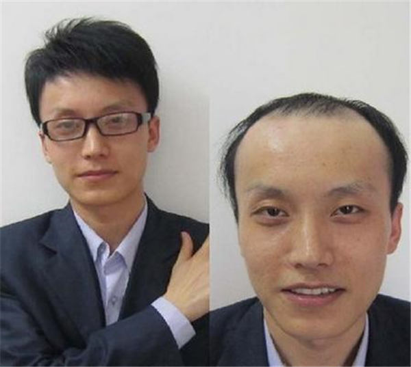 织发补发假发价格是多少？如何正确选择织发补发机构？
