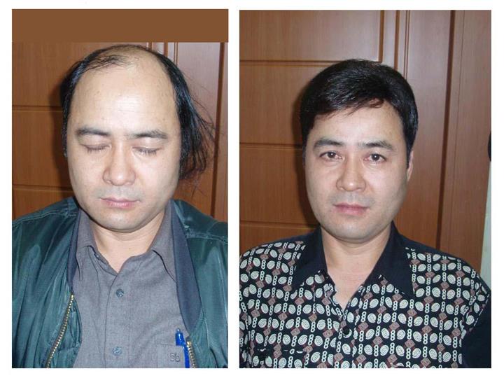 织发补发假发价格