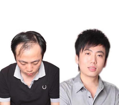 织发补发可以正常洗头吗？织发补发需要注意什么？