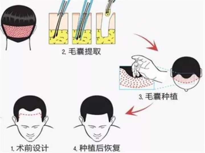 植发大概多少钱呢？植发有没有什么副作用？