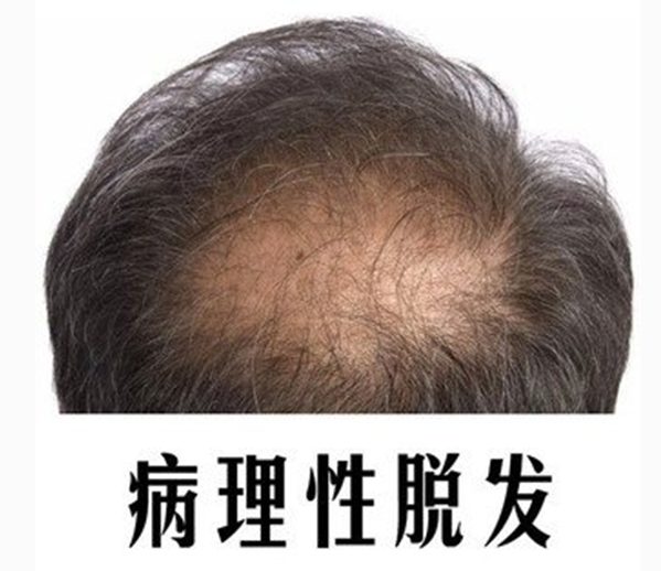 脱发如何治疗 怎样用生姜治疗脱发