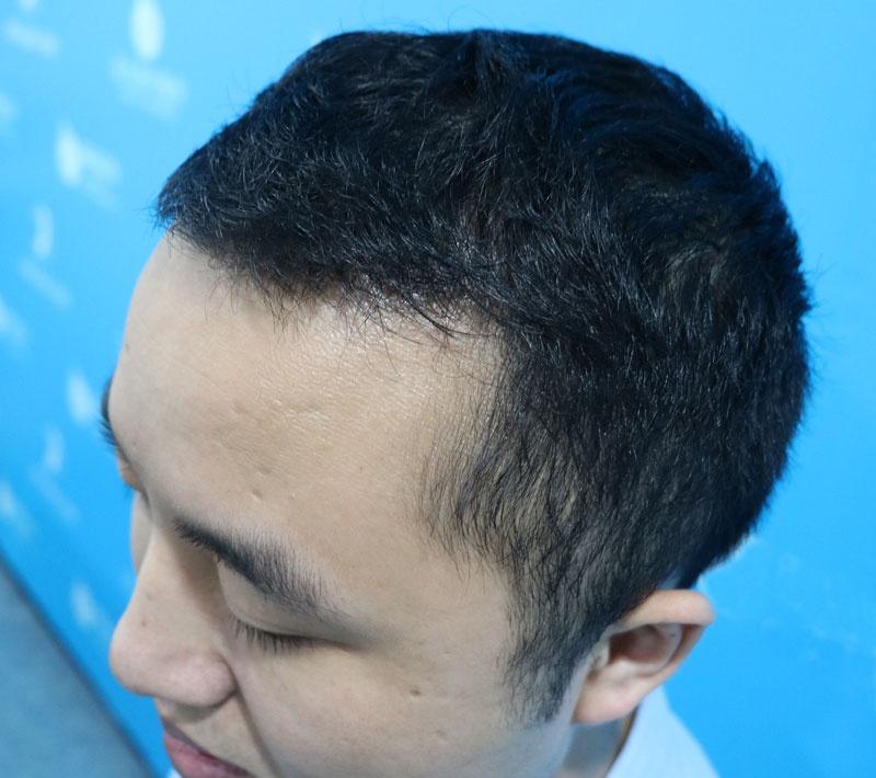 m型脱发如何治疗？脱发可以直接补发吗？