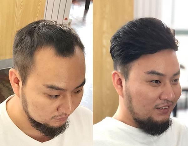 补发织发价格是多少钱?补发织发有什么优势?