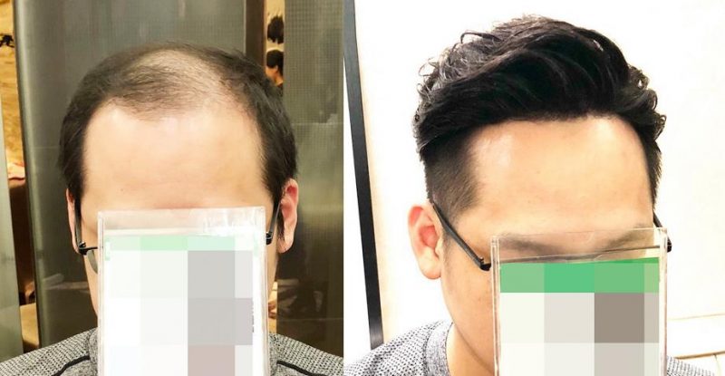 日本生发液可以生发吗？生发液有什么副作用？