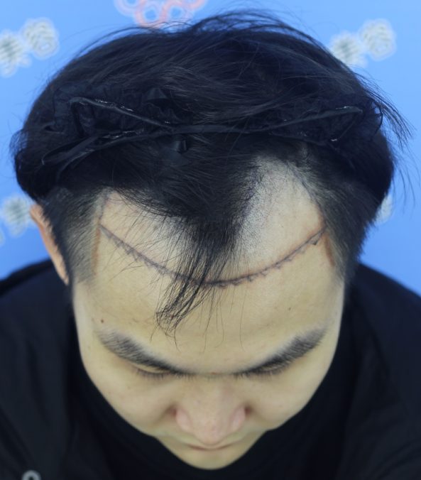 植发后40天头发没怎么长长