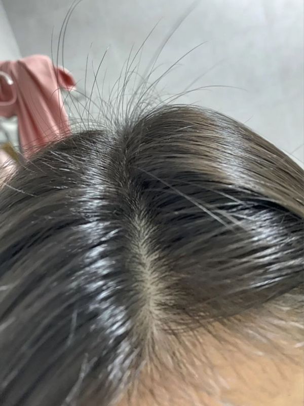 脱发对比