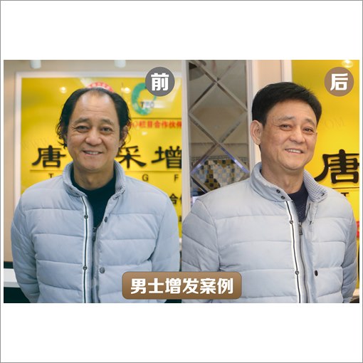 唐风采生物头皮多少钱，价格是怎么计算的