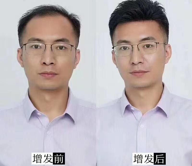 天津黑黛增发补发织发中心怎么样？补发的特点有哪些