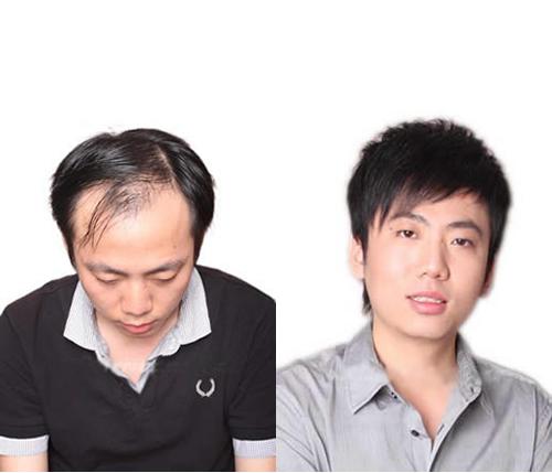 黑黛织发怎么样？织发补发大概能用多久