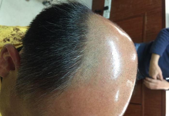 唐风采多少钱？为何新生的头发也会掉？