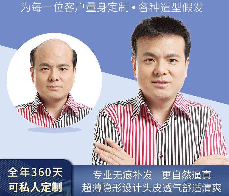 唐风采增发费用多少钱啊？女性脂溢性脱发怎么办？