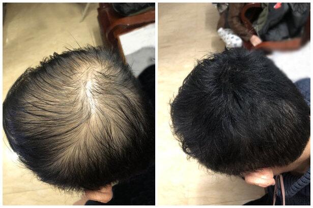 生发老中医偏方，植发的危害和后遗症你了解吗？