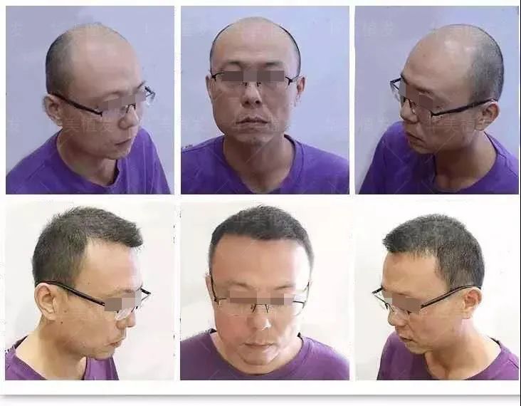 植发前后对比 利大于弊