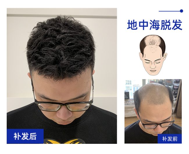 极客与唐风采补发多少钱？织发和植发有什么区别？