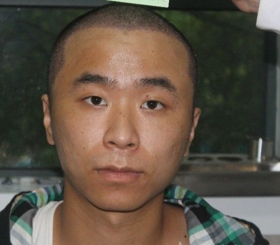 头秃怎么办?看看植发效果图吧