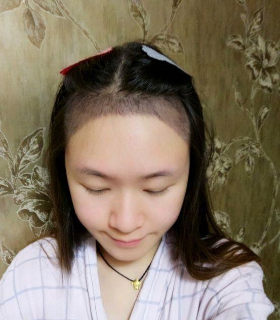 头秃怎么办?看看植发效果图吧