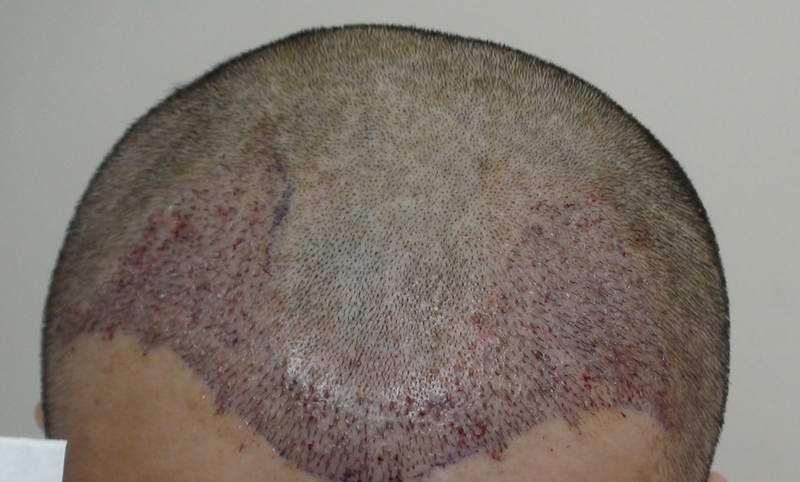 植发4000单位效果图是怎样的？植发4000单位多少钱？