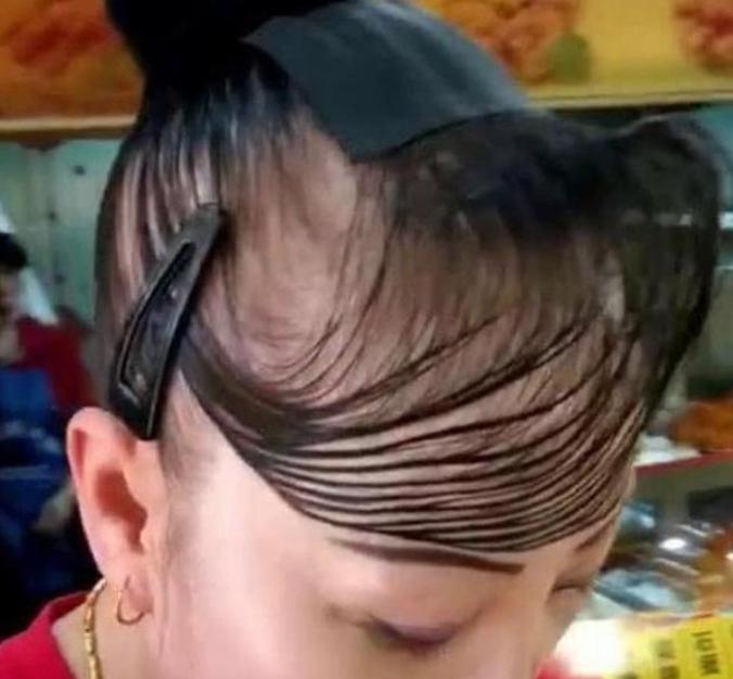 植发半年惨不忍睹图片是怎样的？植发半年惨不忍睹怎么回事？