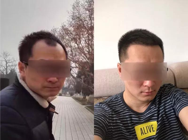 植发可以维持多久呢 知乎