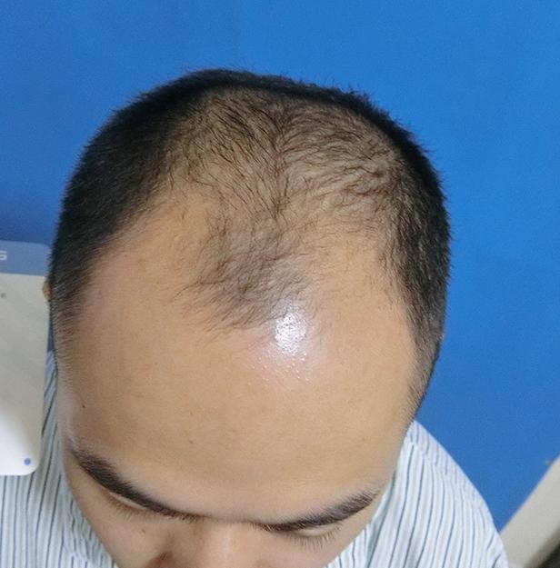 植发手术后悔死了