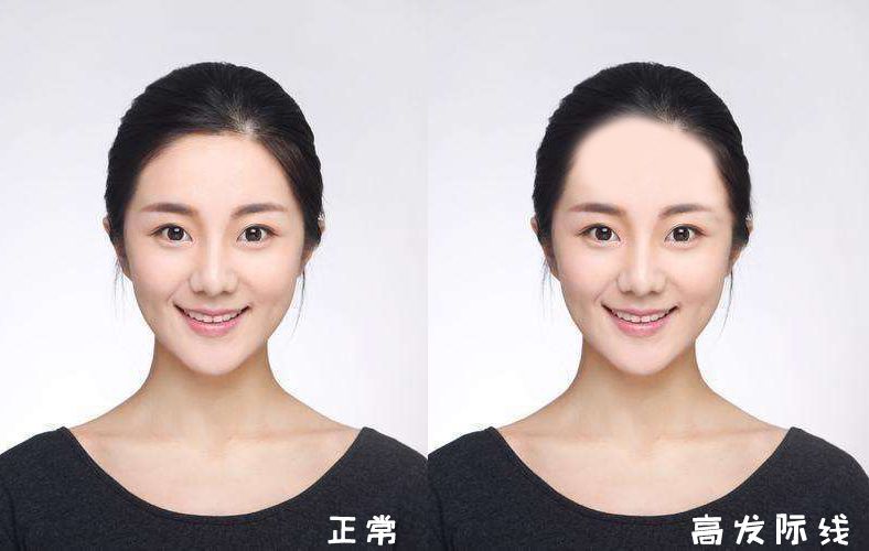 植发一个月效果图