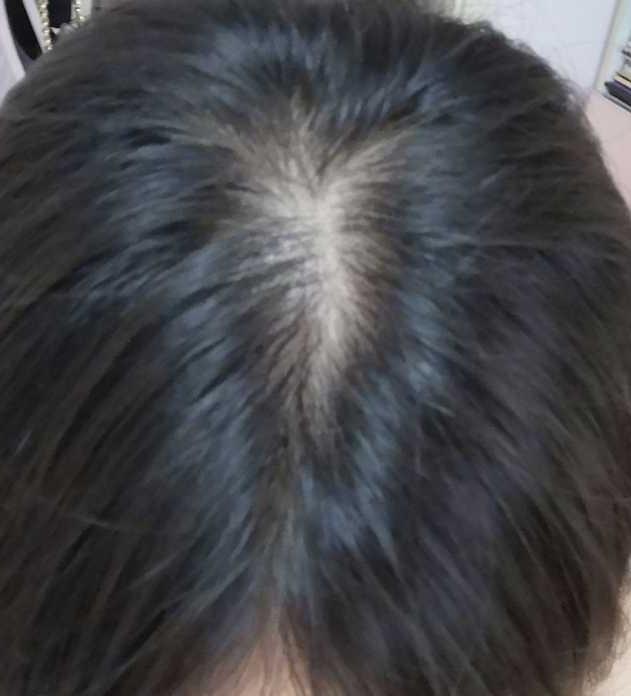 生发广告可信吗？生发的方法有哪些？