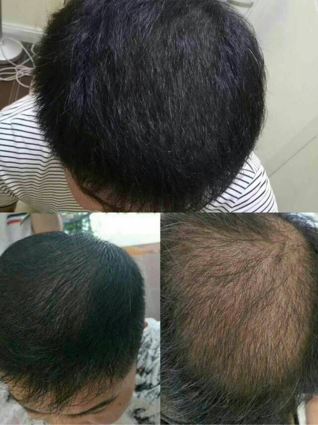 快速生发,生发什么牌子的产品好,如何选择生发产品