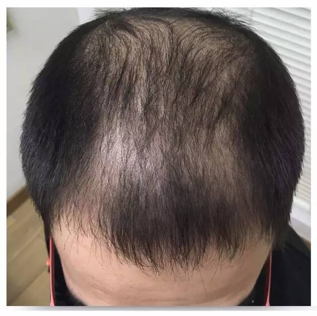 目前最靠谱的生发产品是什么？生发食物有哪些？