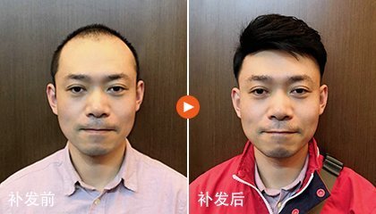 极客补发和植发哪个好？
