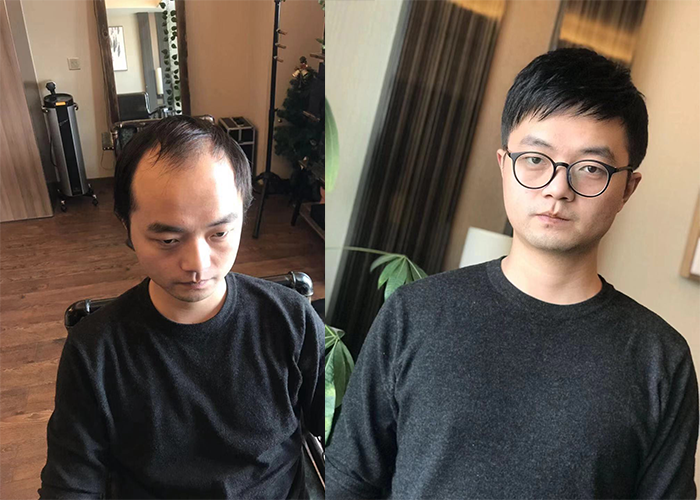 太原假发定制一般多少钱？