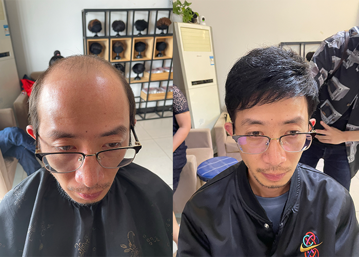 脱发怎么办怎么治疗再生发？